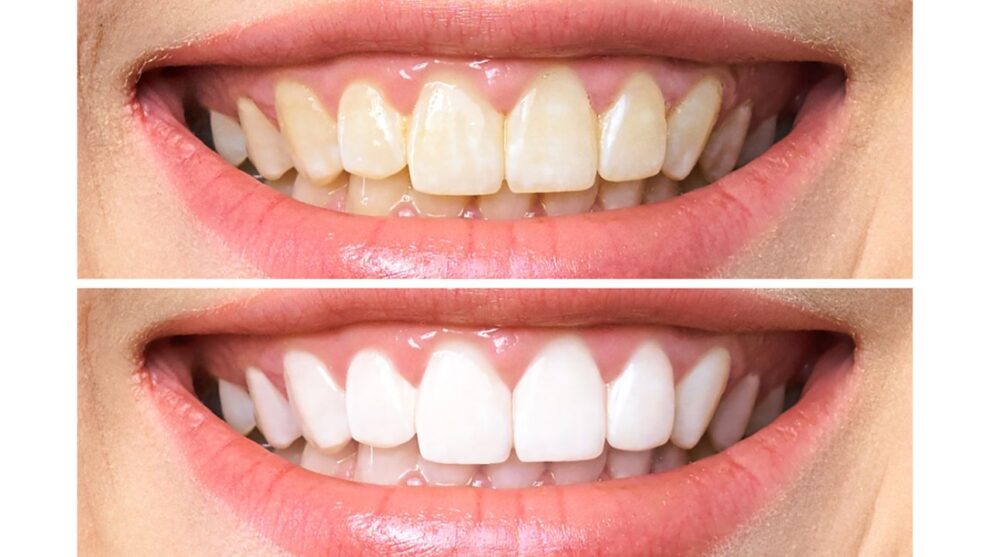 5 formas de clarear seus dentes naturalmente